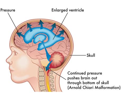 Chiari Malformation and Syringomyelia: What You Should Know - The Spine ...