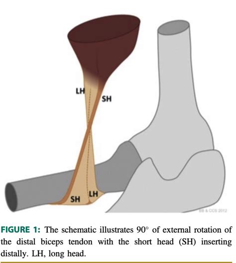 Distal Biceps Tendon Tear - Sports Medicine Review