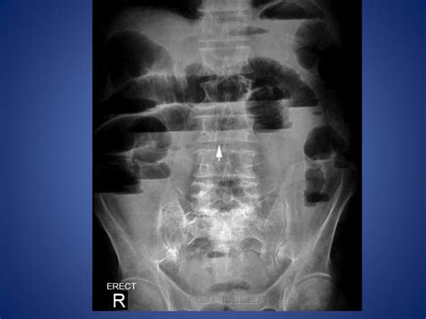 Paralytic ileus