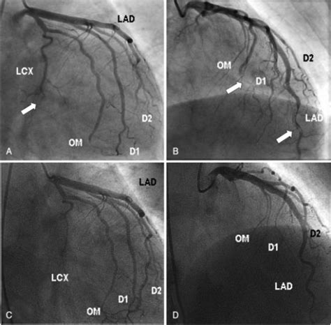 Figure 3:A Case of Acute Myocardial Infarction Caused by Distal ...