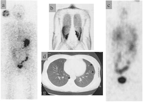 (Case 7) 32-yr-old female with lung metastases from papillary thyroid ...