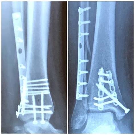 Broken Ankle Surgery Recovery After Trimalleolar Fracture - Whole ...