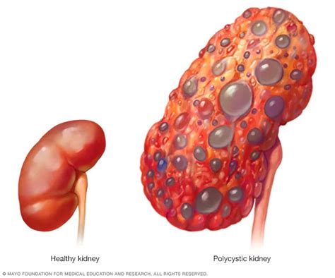 Polycystic kidney disease - Symptoms and causes - Mayo Clinic