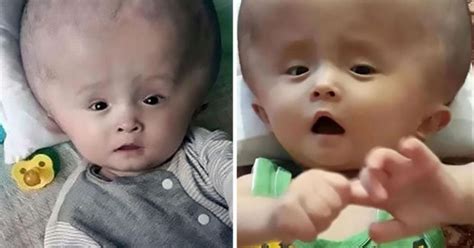 Baby suffers from HUGE head – and it won't stop growing - Daily Star