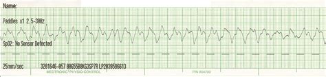 Float Nurse: Pediatric cardiac arrest: PEA