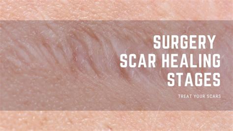 Surgery Scar Healing Stages - Treat Your Scars