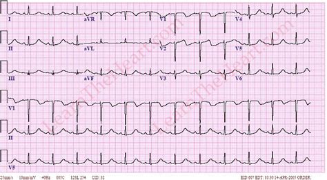 Hypocalcemia ECG Example | LearntheHeart.com