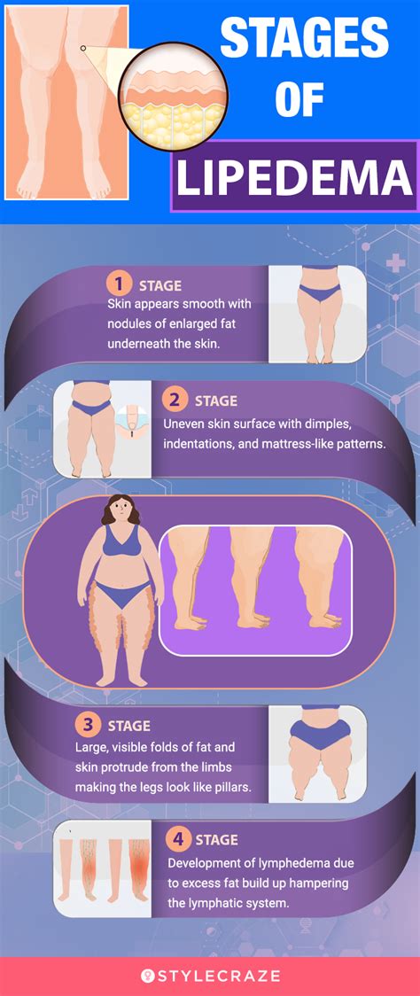 6 Health Benefits Of Lipedema Diet, Exercise, & What To Eat