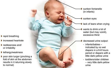 How to Spot Dehydration in Babies - First Aid for Free