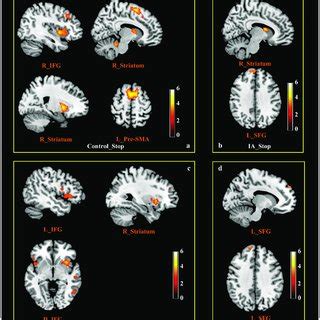 | Brain activation during response inhibition in the controls and the ...