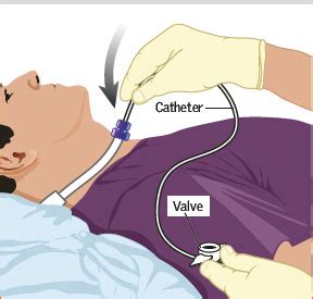 Tracheostomy Tube Suctioning