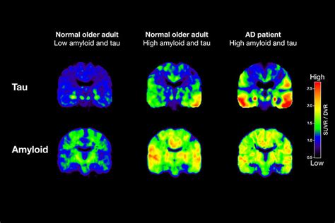 PET scans reveal key details of Alzheimer's protein growth in aging ...