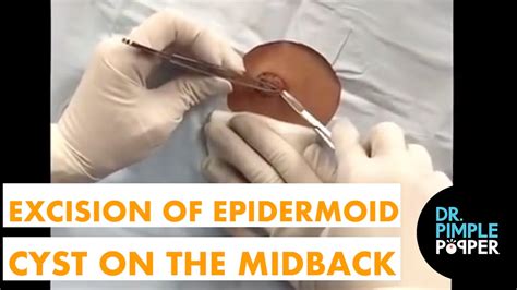 Excision of an Epidermoid Cyst on the Midback - Oozy Offerings - Dr ...