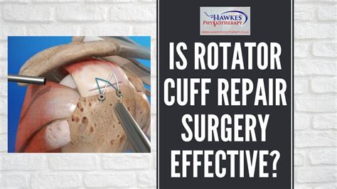 Rotator Cuff Surgery Ultrasound