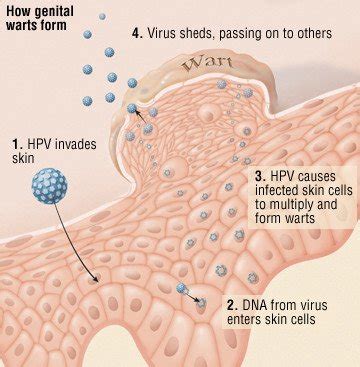 Genital Warts Guide: Causes, Symptoms and Treatment Options