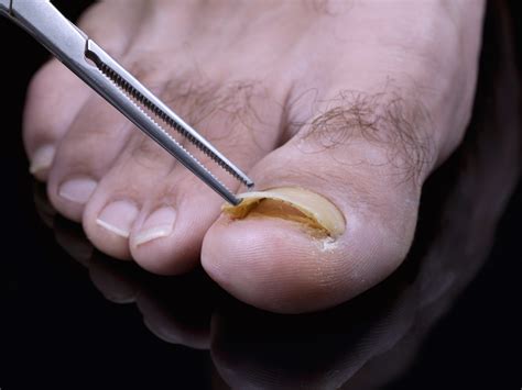 Toenail fungus treatment - Atlanta Podiatrists: Atlanta Foot and Ankle ...