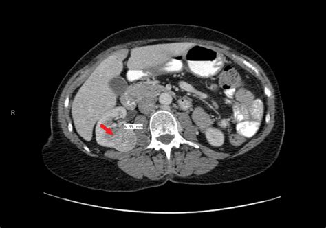 Renal Oncocytoma Mimicking Renal Cell Carcinoma | Consultant360