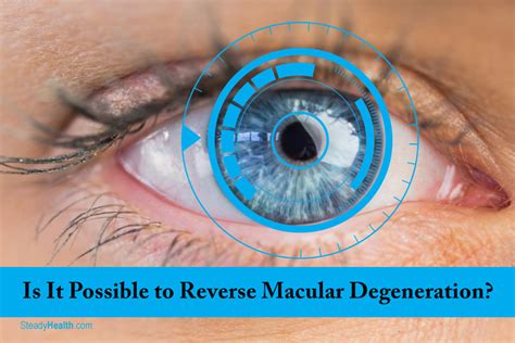 Is It Possible to Reverse Your Macular Degeneration? | Eye Disorders ...