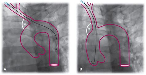 Tips and Tricks for Diagnostic Angiography and Intervention | Thoracic Key