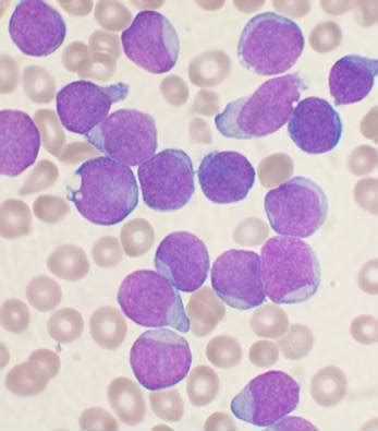 Bone marrow examination - Wikipedia