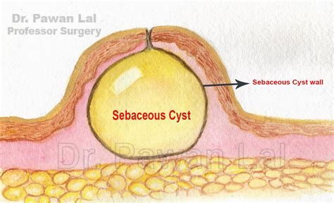 Epidermoid Cyst Diagram