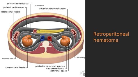 Retroperitoneal hematoma – NephroPOCUS