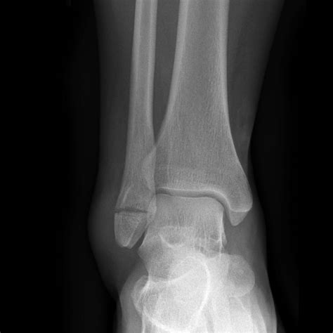 Ankle fracture - wikidoc