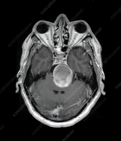 Brain aneurysm, MRI - Stock Image - C023/9779 - Science Photo Library