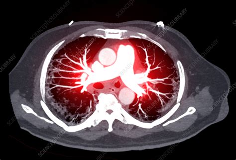 Pulmonary artery, CT scan - Stock Image - F037/7325 - Science Photo Library