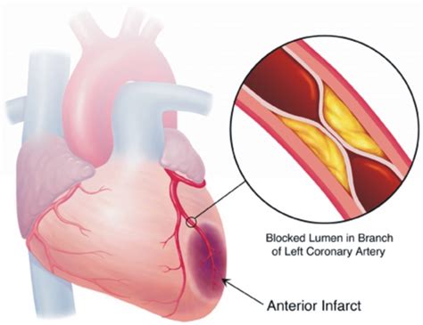 Myocardial Ischemia Causes, Symptoms, Diagnosis and Treatment - Natural ...