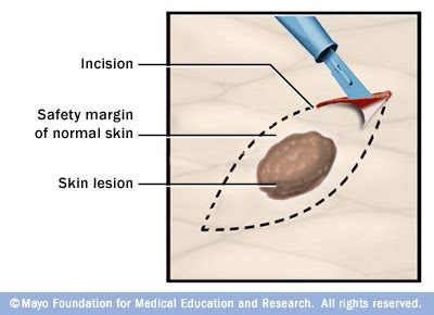 Solving the Puzzle - Excisional vs Shave Biopsy - Miller Family ...