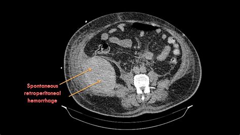 Ultimate Radiology : Spontaneous Retroperitoneal Hemorrhage