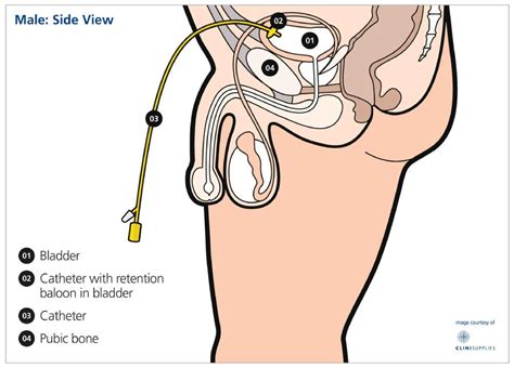 You and your catheter — Urology Associates