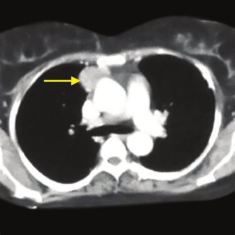 Anterior mediastinal mass (arrow) Fig. 2: Tumor arising from the body ...