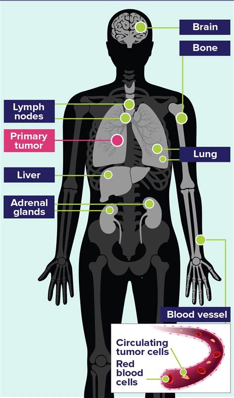 SCLC Diagnosis & Symptoms | rethinkSCLC