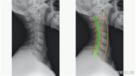 Cervical Spine X Ray / Cervical Spine X-ray | Cervical Spine -- Left ...