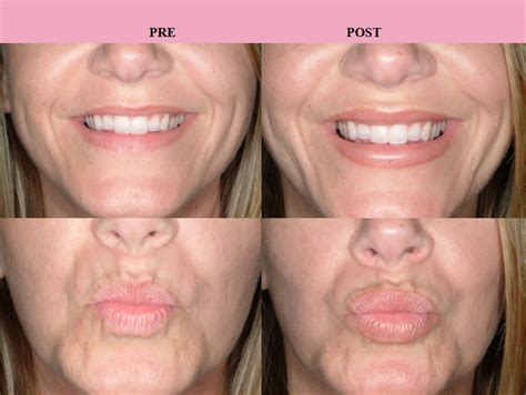 Redefining the Face Of Beauty : LIP AUGMENTATION: EDUCATION 101