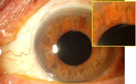 Glaucoma Information Secondary glaucoma - Can diabetes cause glaucoma ...