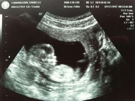 Travis & Danielle: 13 week ultrasound