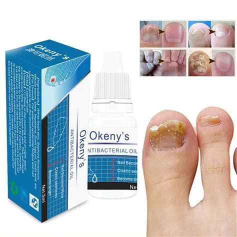 Remedy For Nail Fungus Treatment Feet Care Essence Whitening Toe From ...