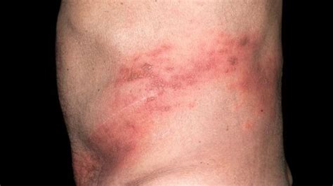 Q&A: Shingles - BBC News