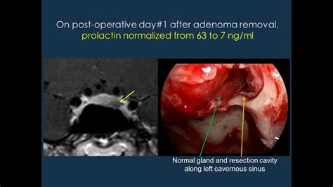 Prolactinoma Surgery