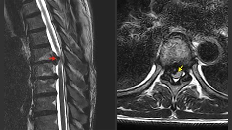 Herniated Disc Thoracic Mri