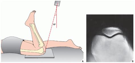 Lower Limb II: Knee | Radiology Key