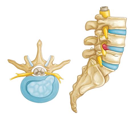 Herniated Disc