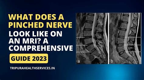 What Does a Pinched Nerve Look Like on an MRI? A Comprehensive Guide ...