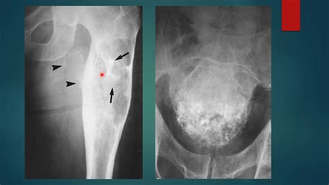 Chondrosarcoma xray || Chondrosarcoma radiology|| Bone tumors - YouTube