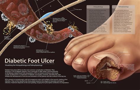 Diabetic foot ulcers: Surgery options to treat and prevent podiatric ...