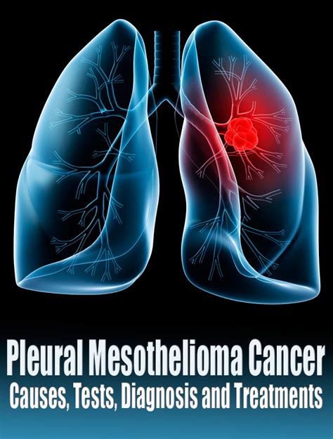 Pleural Mesothelioma Cancer - Causes, Tests, Diagnosis and Treatments