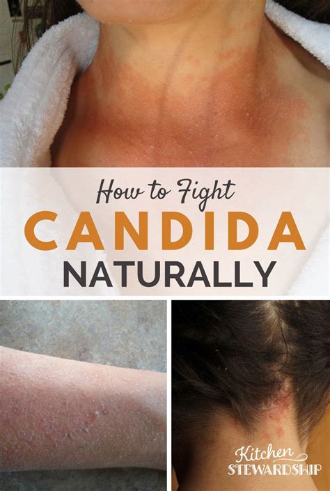 3 Steps to Fighting Candida Naturally (Part 2 of the Story)